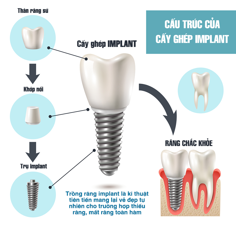 Trồng răng Implant giá bao nhiêu? Chi phí gồm những gì và có phát sinh không? 2