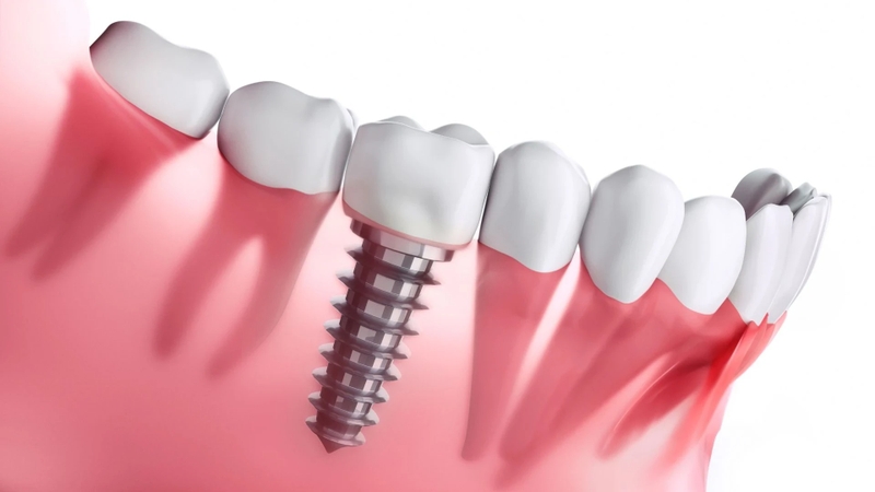Trồng răng Implant là gì? Quy trình, ưu nhược điểm và chi phí 1