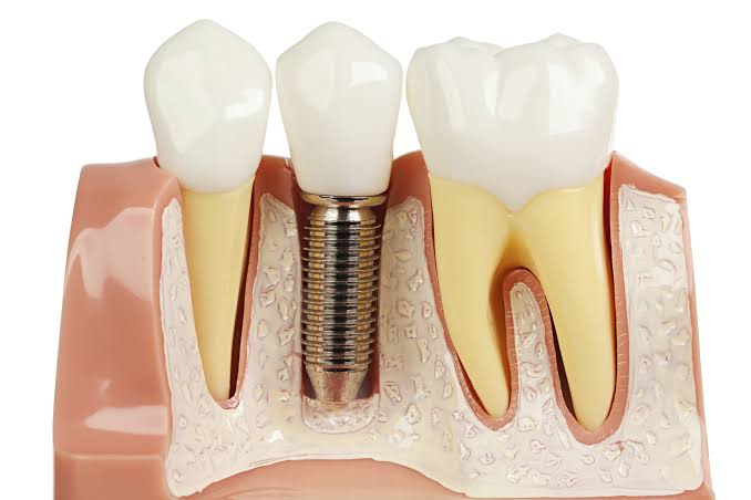 Trồng răng Implant mất bao lâu? Các giai đoạn phục hình 1