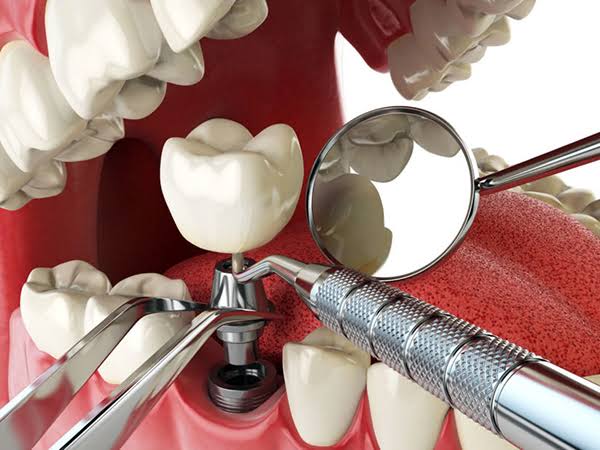 Trồng răng Implant mất bao lâu? Các giai đoạn phục hình 3 Trồng răng Implant mất bao lâu? Các giai đoạn phục hình 2