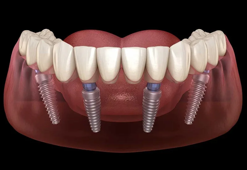 Trồng răng Implant mất bao lâu? Các giai đoạn phục hình 12 Trồng răng Implant mất bao lâu? Các giai đoạn phục hình 11