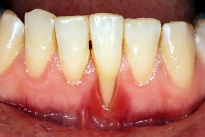 Viêm nha chu có thể làm răng lung lay
