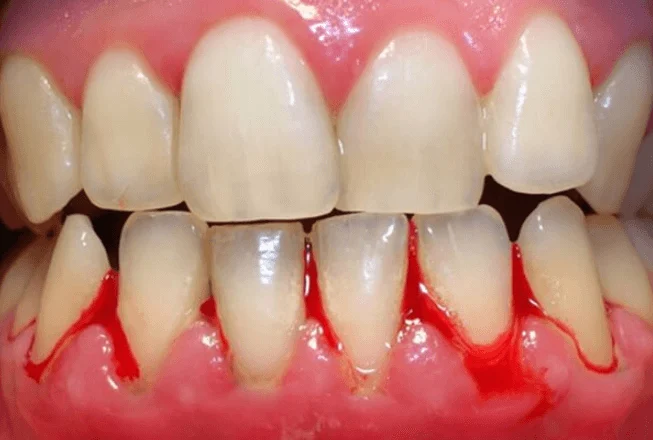 Tình trạng chảy máu chân răng