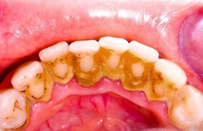 Viêm nha chu có chữa khỏi được không? Khả năng điều trị và bảo tồn răng 5 Nên đi lấy cao răng định kỳ 6 tháng/lần