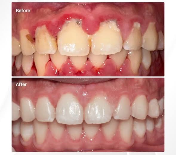 Viêm nha chu có chữa khỏi được không? Khả năng điều trị và bảo tồn răng 3 Viêm nha chu hoàn toàn có thể chữa khỏi nếu chọn nha khoa uy tín