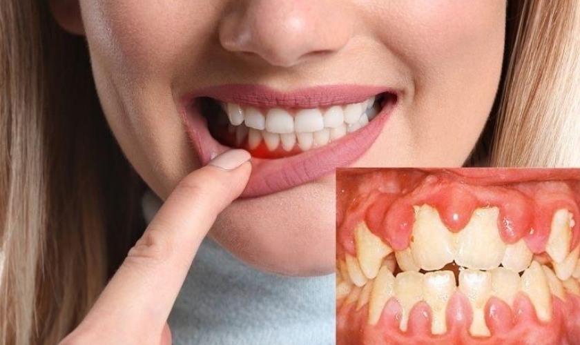 Viêm nha chu là gì? Nguyên nhân, triệu chứng và cách điều trị 3 Cần phân biệt viêm nướu và viêm nha chu