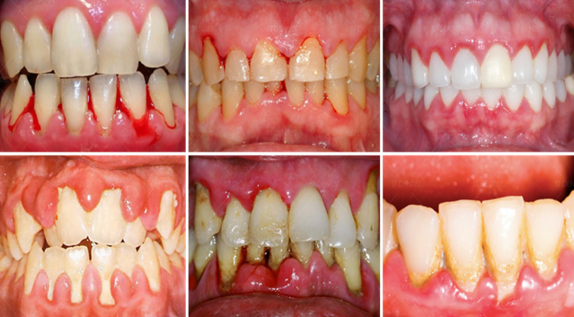 Các tình trạng viêm nha chu phổ biến