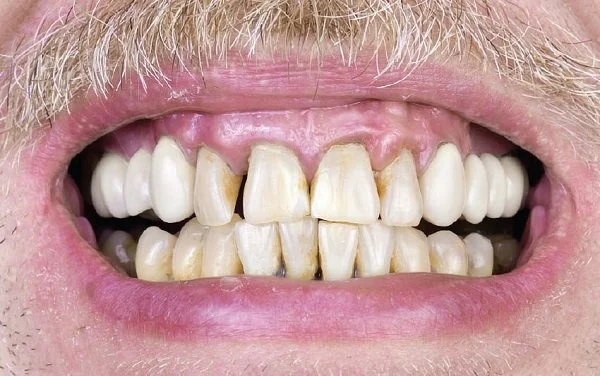 Viêm nha chu là gì? Nguyên nhân, triệu chứng và cách điều trị 4 Viêm nha chu do hút thuốc lá